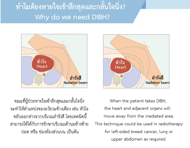 วิธีฝึกปฏิบัติการหายใจเข้าลึกสุดและกลั้นใจนิ่งสำหรับการฉายรังสี