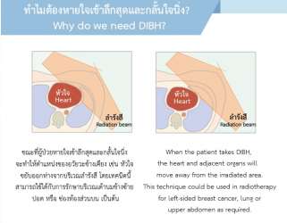 วิธีฝึกปฏิบัติการหายใจเข้าลึกสุดและกลั้นใจนิ่งสำหรับการฉายรังสี