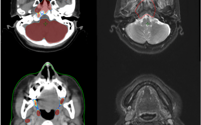 การจำลองโดยใช้ภาพจากเครื่องเพ็ทซีที (PET/CT simulator)