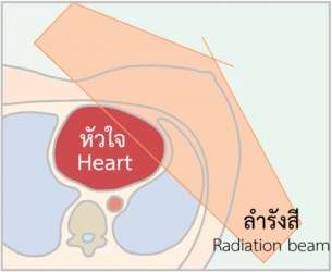 วิธีฝึกปฏิบัติการหายใจเข้าลึกสุดและกลั้นใจนิ่งสำหรับการฉายรังสี