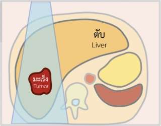 การปฏิบัติตนสำหรับผู้ป่วยที่ได้รับการใส่แร่ 